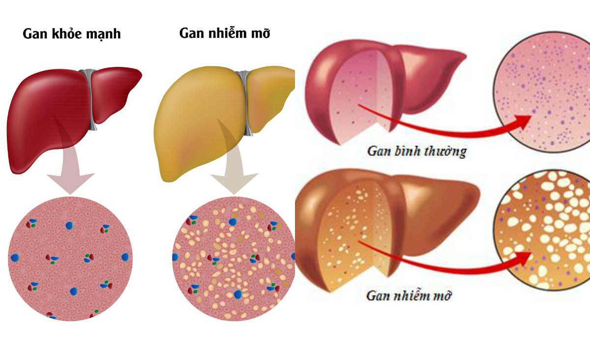 90% người dùng rượu bia nhiều bị gan nhiễm mỡ